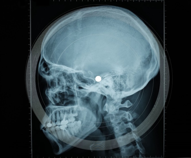 torture-victim-testimonies-x-rays